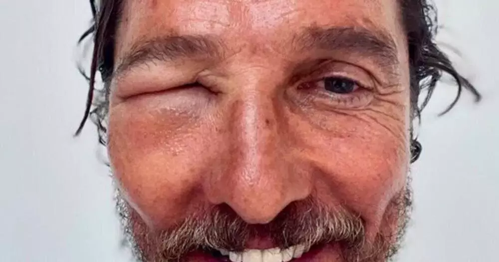 Matthew McConaughey posts selfie of bee sting above his eye