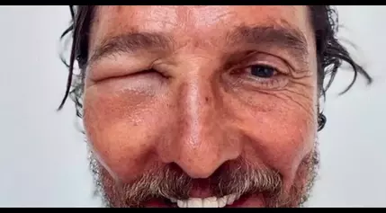 Matthew McConaughey posts selfie of bee sting above his eye