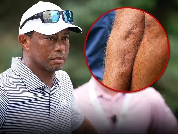 Tiger Woods Shows Off Gnarly Leg Scars Three Years After Car Crash